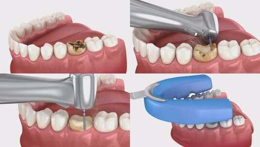 除龋、准备、印模和牙冠放置高清在线视频素材下载