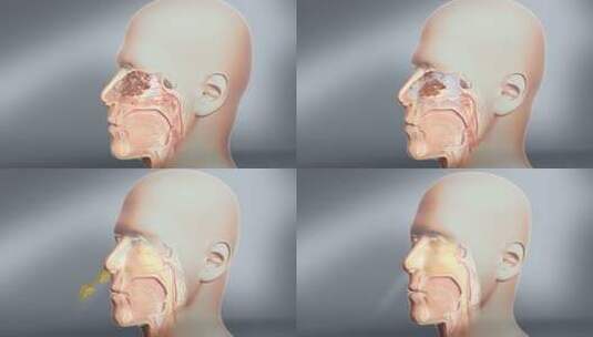 过敏性鼻炎 季节性鼻炎 鼻炎鼻粘膜高清AE视频素材下载