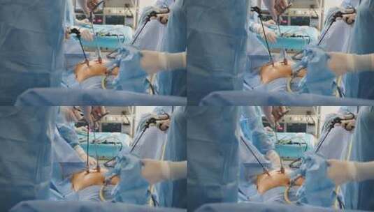 孕妇在医院进行剖腹产手术实拍素材高清在线视频素材下载