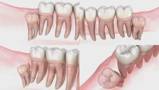 智齿的垂直、水平和远端嵌塞高清在线视频素材下载