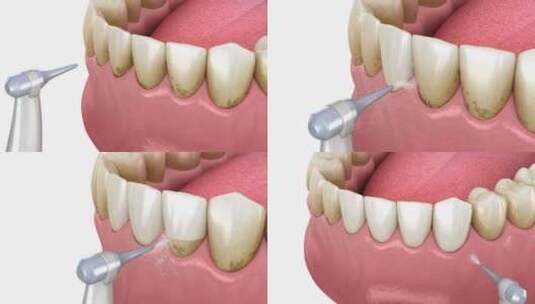 口腔卫生：气流水牙齿清洁高清在线视频素材下载