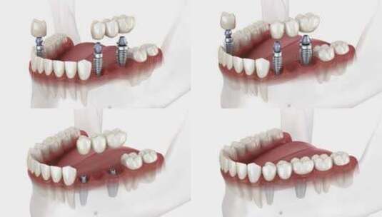 种植体上的牙桥和牙冠放置。牙科3D动画概高清在线视频素材下载