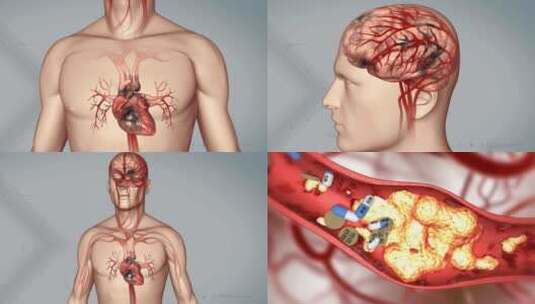 血管堵塞 自由基 粥样硬化 脑血栓高清在线视频素材下载