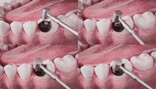 镶嵌陶瓷皇冠放置。医学上精确的3D动画高清在线视频素材下载