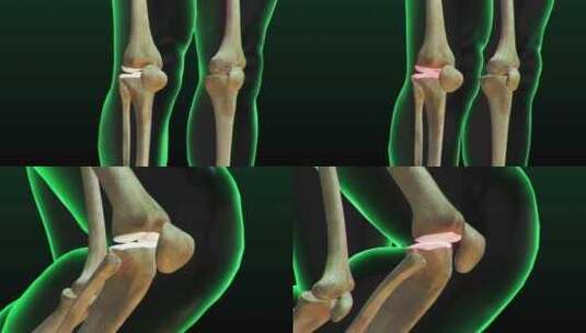 膝盖疼痛、锻炼受伤和骨关节炎高清在线视频素材下载