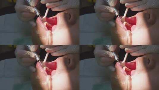 亚洲人口腔护理整牙洗牙高清在线视频素材下载