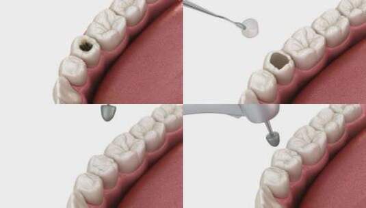 前牙复合充填修复术高清在线视频素材下载