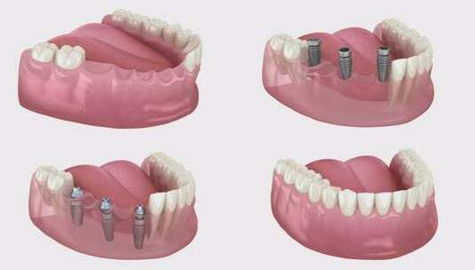 基于3种种植体的牙桥高清在线视频素材下载