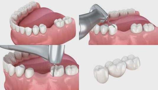 牙桥放置。医学上精确的3D动画高清在线视频素材下载