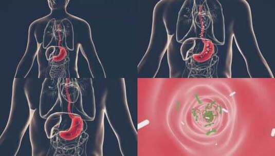 胃酸Relux。食道，gerd高清在线视频素材下载