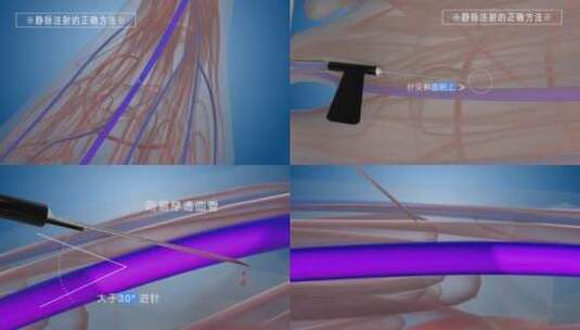 静脉注射血管医学输液高清AE视频素材下载