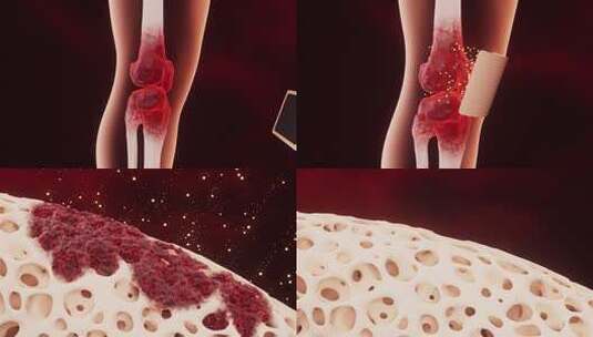 3d膏药治疗风湿关节炎动画高清在线视频素材下载