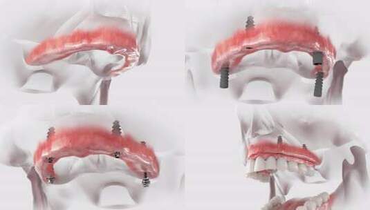 为上颚安装牙齿的假体高清在线视频素材下载
