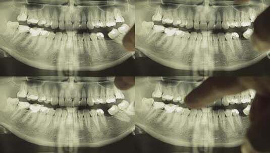 牙医X片照片高清在线视频素材下载