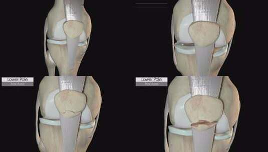 髌骨骨折下极高清在线视频素材下载