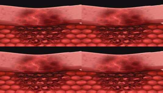 细胞发生病变坏死  坏疽 糖尿病 感染病毒高清在线视频素材下载