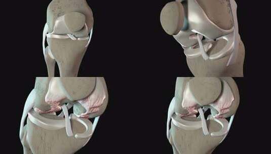 膝盖软骨组织受损高清在线视频素材下载