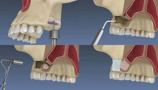 带侧向通道的鼻窦提升手术。牙科手术的3D高清在线视频素材下载