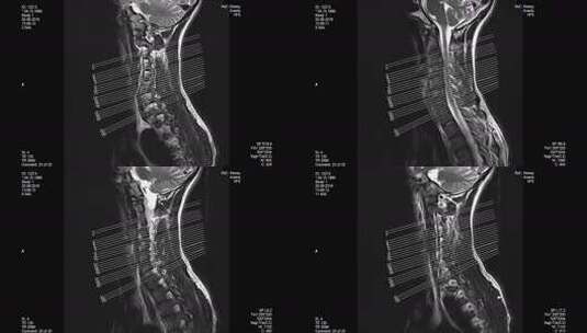 MRI扫描，腰椎，显示尺寸高清在线视频素材下载