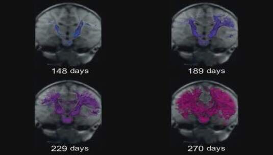 大脑生长高清在线视频素材下载