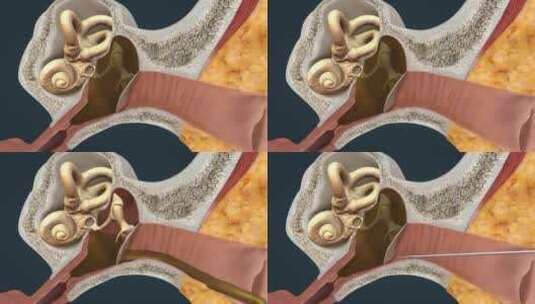 中耳炎医学三维动画高清在线视频素材下载