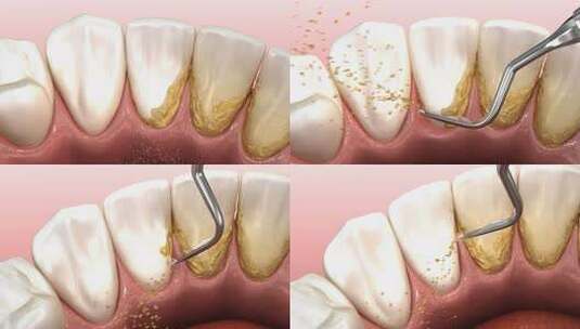 口腔卫生：超声波洗牙机去除牙结石和牙菌斑高清在线视频素材下载