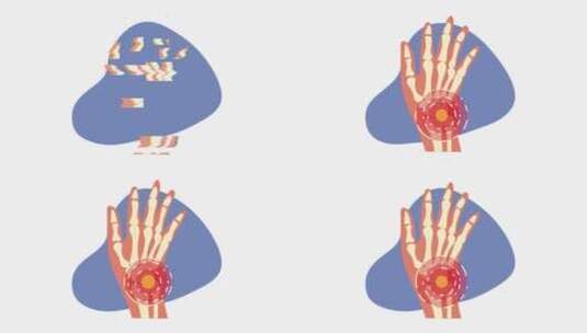 人手骨骼疼痛动画高清在线视频素材下载