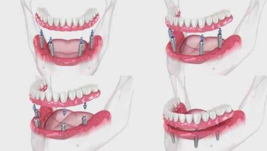 医学牙科牙齿矫正修复3D模拟演示高清在线视频素材下载