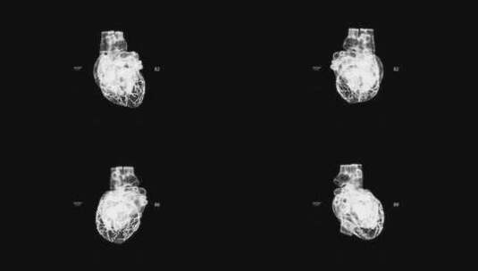 人体心脏高清在线视频素材下载