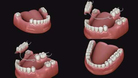 可摘局部义齿，下颌假体高清在线视频素材下载