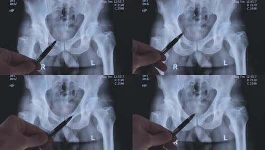 疾病脊柱高清在线视频素材下载