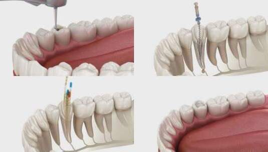 牙髓根管治疗过程高清在线视频素材下载