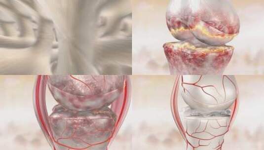 膝关节修复三维动画高清在线视频素材下载