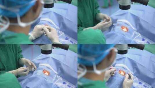 白内障手术高清在线视频素材下载