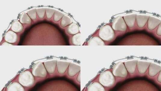 医学口腔牙科牙齿矫正修复3D模拟演示高清在线视频素材下载