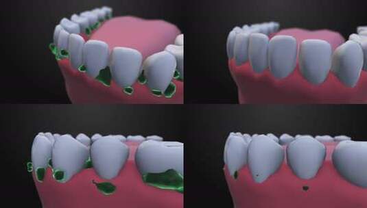 牙齿上的菌斑高清在线视频素材下载