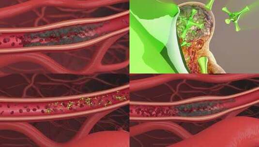 打通血栓 修复血管 血栓 药物分子治疗高清在线视频素材下载