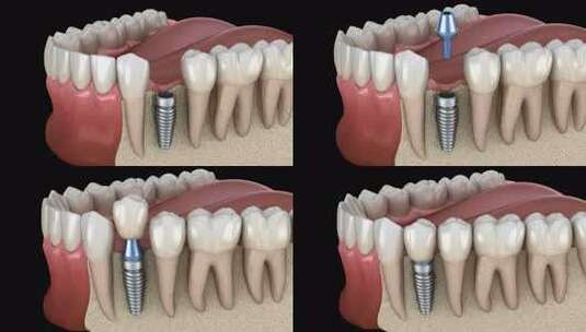 种植体修复前牙。高清在线视频素材下载