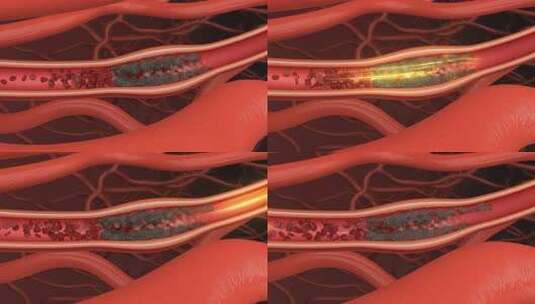 打通血栓 治疗脑血栓 药物治疗 血管血栓高清在线视频素材下载