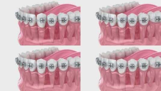 医学牙科牙齿矫正修复3D模拟演示高清在线视频素材下载