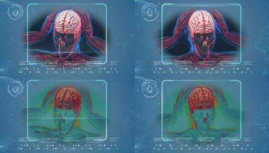 人体大脑病变脑血管病扫描  4K高清在线视频素材下载