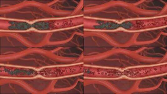 打通血栓 治疗脑血栓 药物治疗 血管血栓高清在线视频素材下载