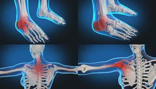 关节炎 风湿  湿骨病 颈椎病 肩周炎高清在线视频素材下载
