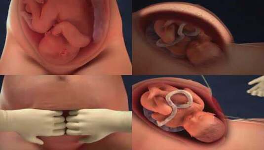 剖腹产手术动画演示高清在线视频素材下载
