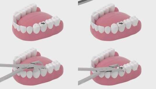 拔出蛀牙动画 3D渲染高清在线视频素材下载