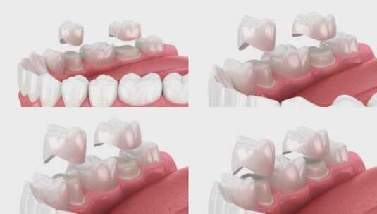 牙冠放置在牙齿上。牙科3D动画高清在线视频素材下载