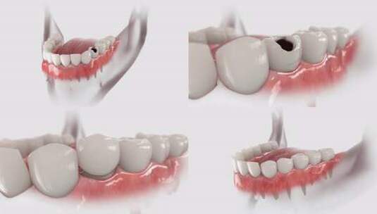 牙齿修复更换牙齿高清在线视频素材下载